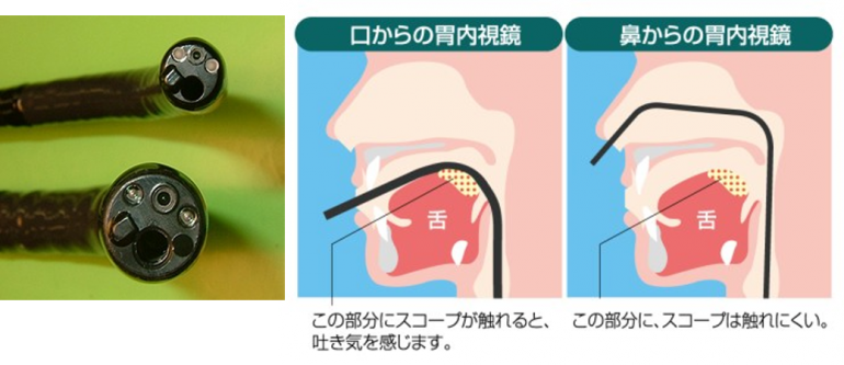 経鼻内視鏡で楽になった胃カメラ検査