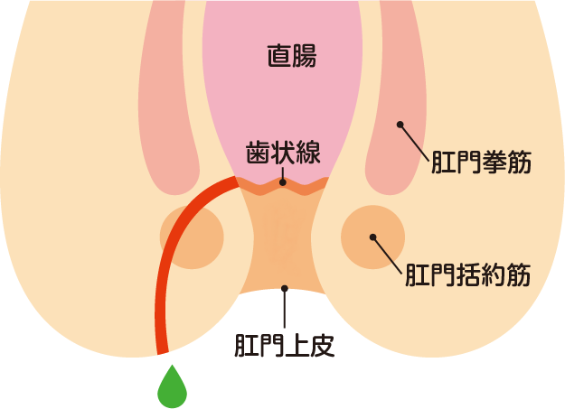 痔ろうとは