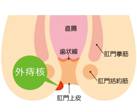 外痔核の症状