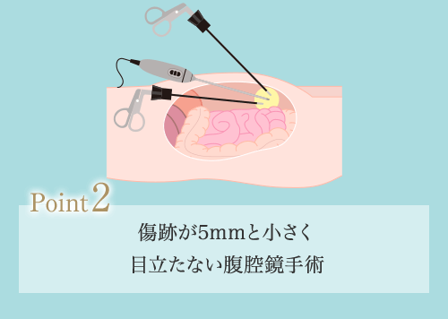 2.傷跡が3～5mmと小さく 目立たない腹腔鏡手術