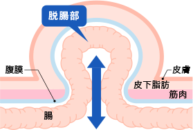 鼠径ヘルニアとは…